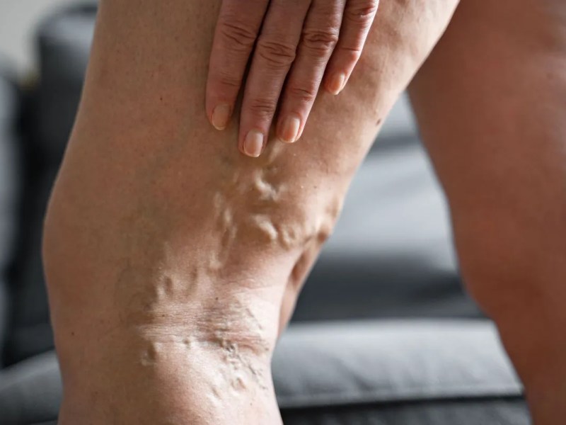 Tenho varizes e tenho medo de ter trombose&nbsp;venosa.