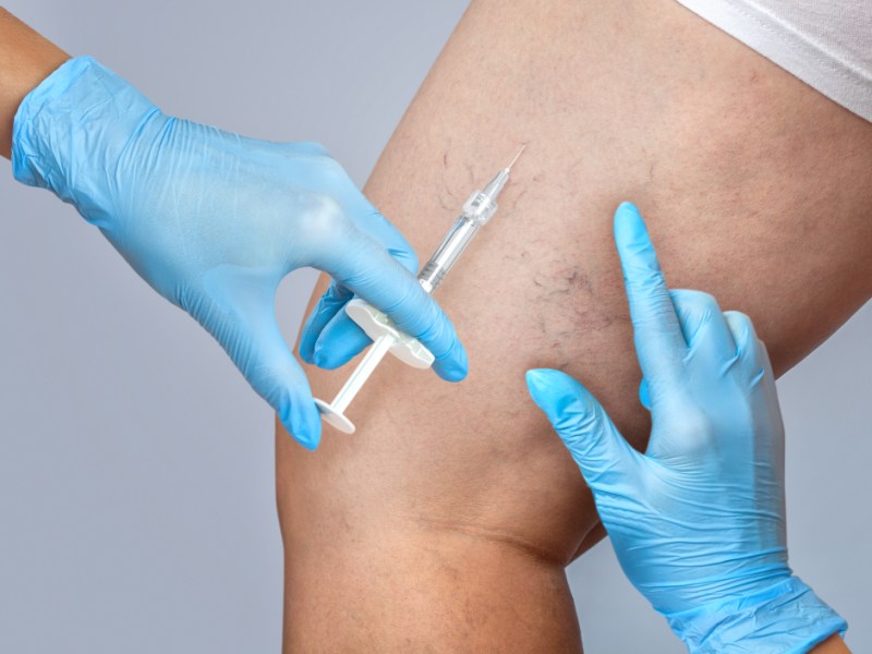 Nunca tive varizes ou vasinhos e agora notei alguns aparecendo, porque isso&nbsp;acontece?